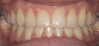 Before & Afters