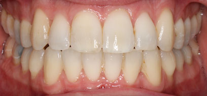 Before & Afters